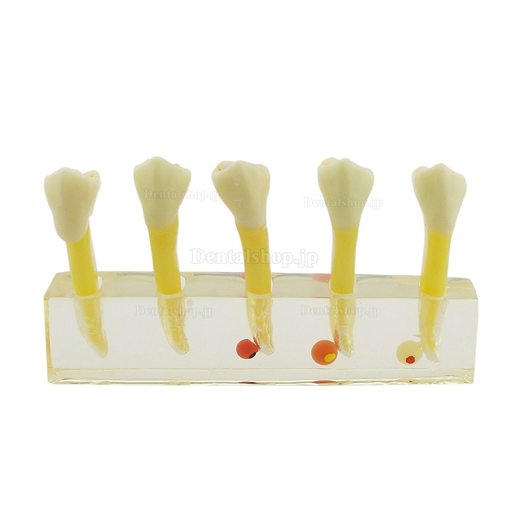 歯科5段階虫歯拡大モデル模型 歯科用虫歯治療説明用 高品質展示用脱着可能歯列模型 クリアベース 