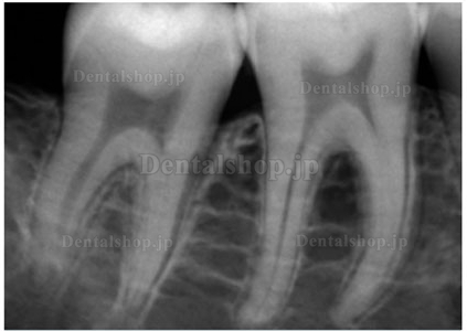 FONA® CDRelite®歯科用デジタルＸ線センサー