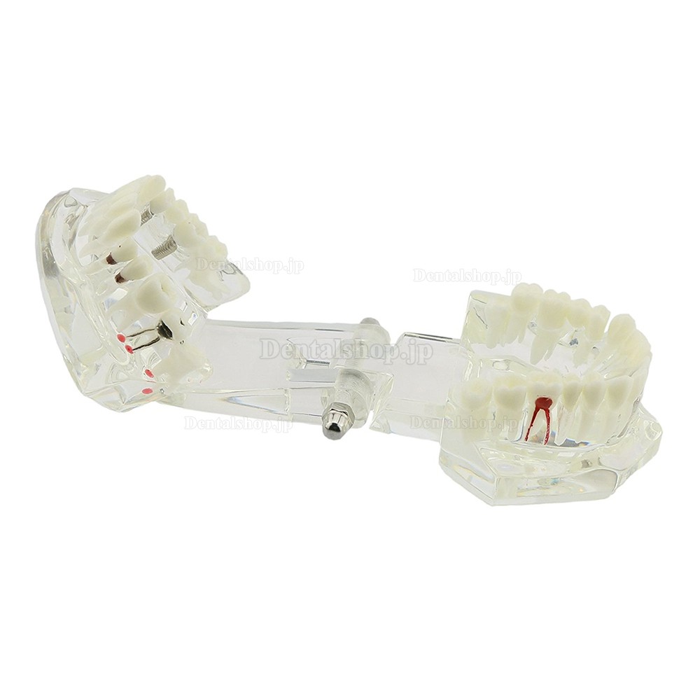 歯科上下顎180度開閉式インプラントモデル模型 虫歯治療説明用透明歯列模型