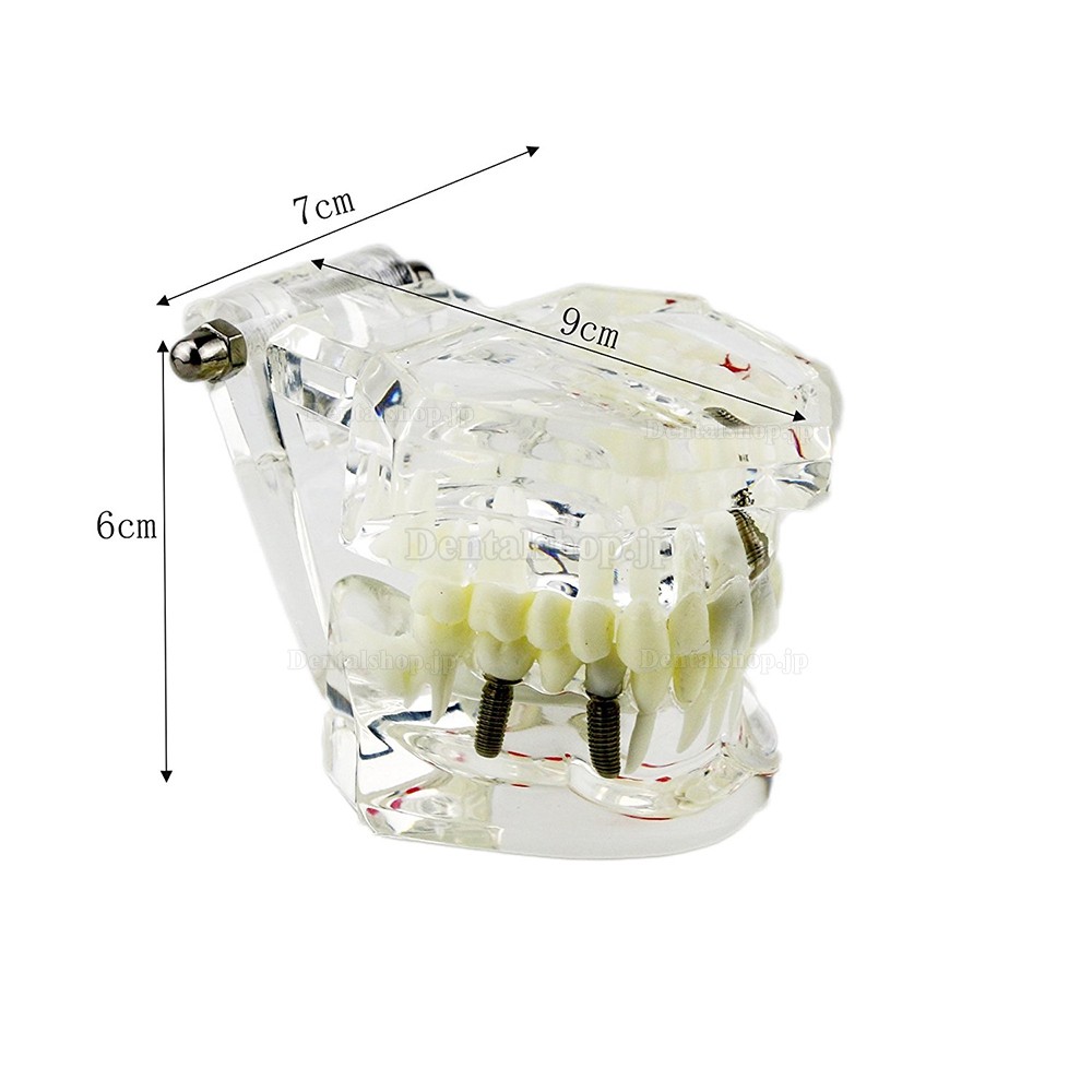 歯科上下顎180度開閉式インプラントモデル模型 虫歯治療説明用透明歯列模型