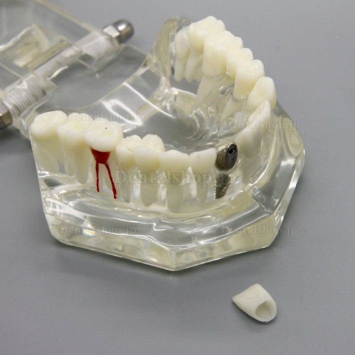 歯科インプラント研究分析用モデル 歯科疾患と回復モデル