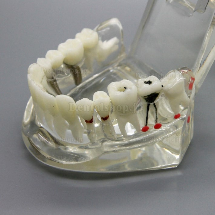 歯科インプラント研究分析用モデル 歯科疾患と回復モデル