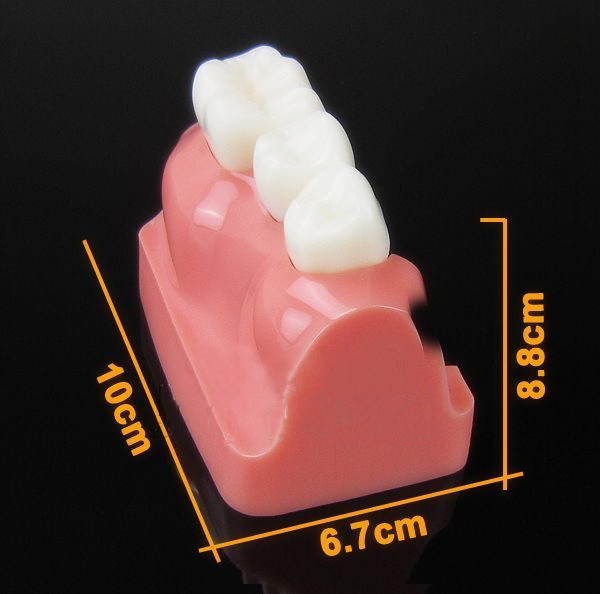 JX®M2017歯科インプラント・クラウン歯模型