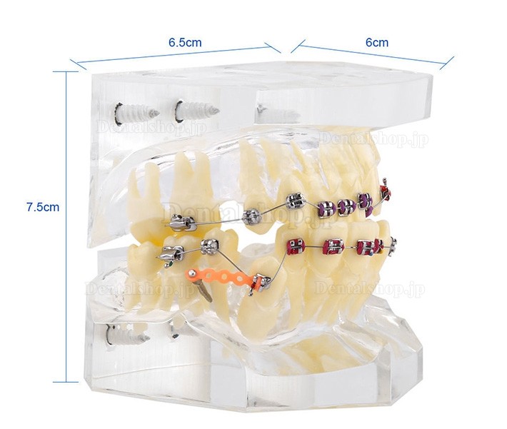 歯科矯正治療不正咬合モデルブラケット・チェーン・ワイヤー付き