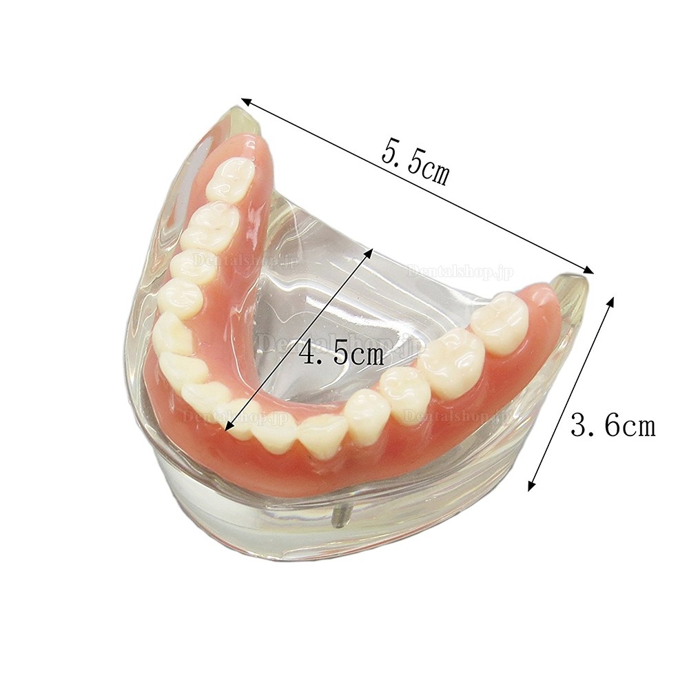 歯科下顎インプラントモデル模型 取り外し可能 高品質歯科インプラント研究治療説明用歯列模型 2本釘 透明 クリアベース