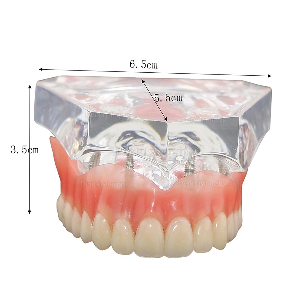 歯科上顎インプラントモデル模型 インプラント研究治療説明用歯列模型 4本釘 取り外し可能