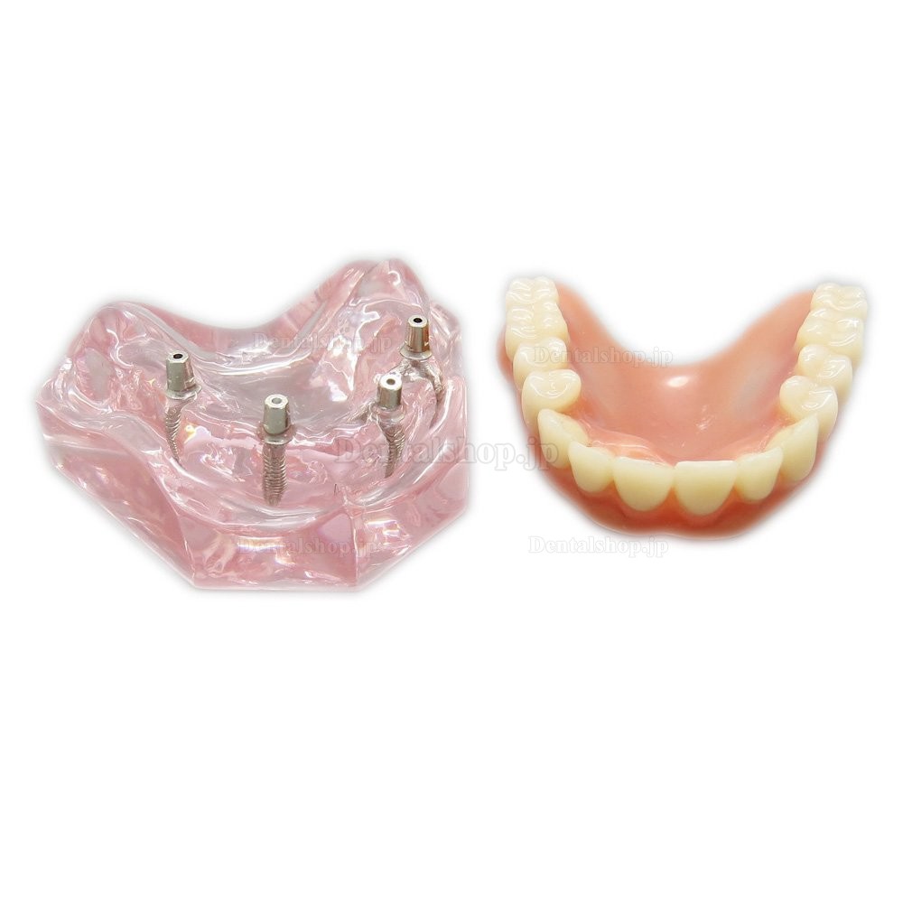 歯科上顎インプラントモデル模型 インプラント研究治療説明用歯列模型 4本釘 取り外し可能
