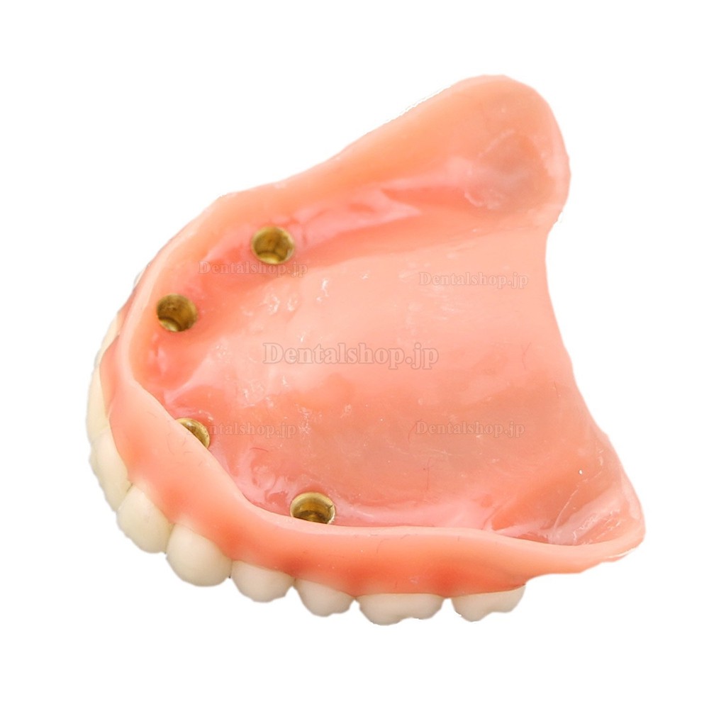 歯科上顎インプラントモデル模型 インプラント研究治療説明用歯列模型 4本釘 取り外し可能