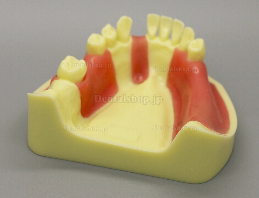 歯科模型 モデル 下顎インプラント練習モデル 歯肉付き #2004 01