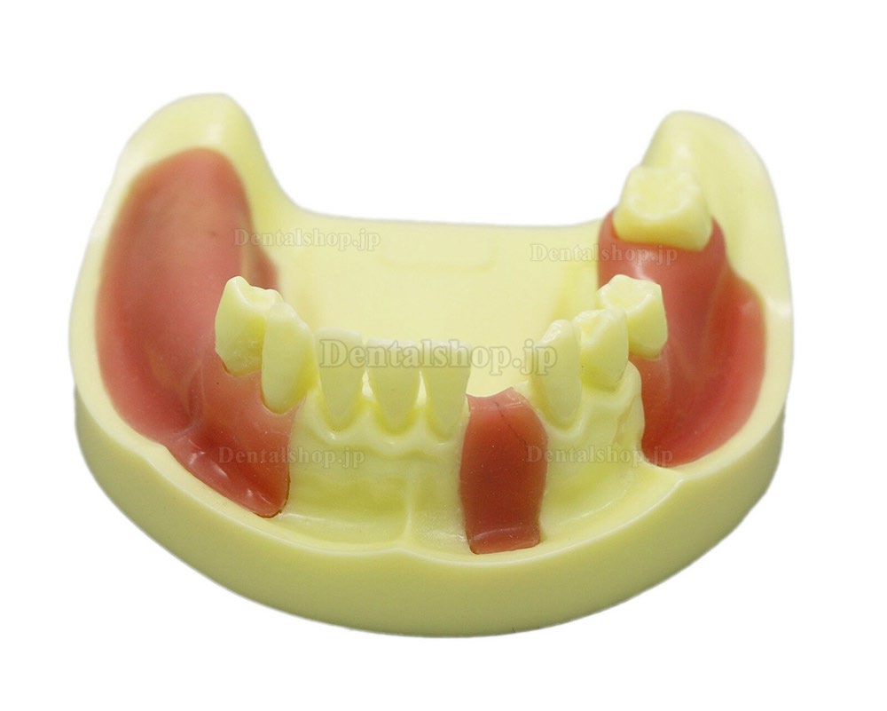 歯科模型 モデル 下顎インプラント練習モデル 歯肉付き #2004 01