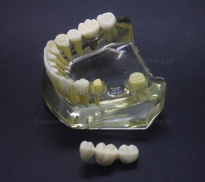 1:1 歯科下顎インプラントモデル インプラント、ブリッジ付き2010