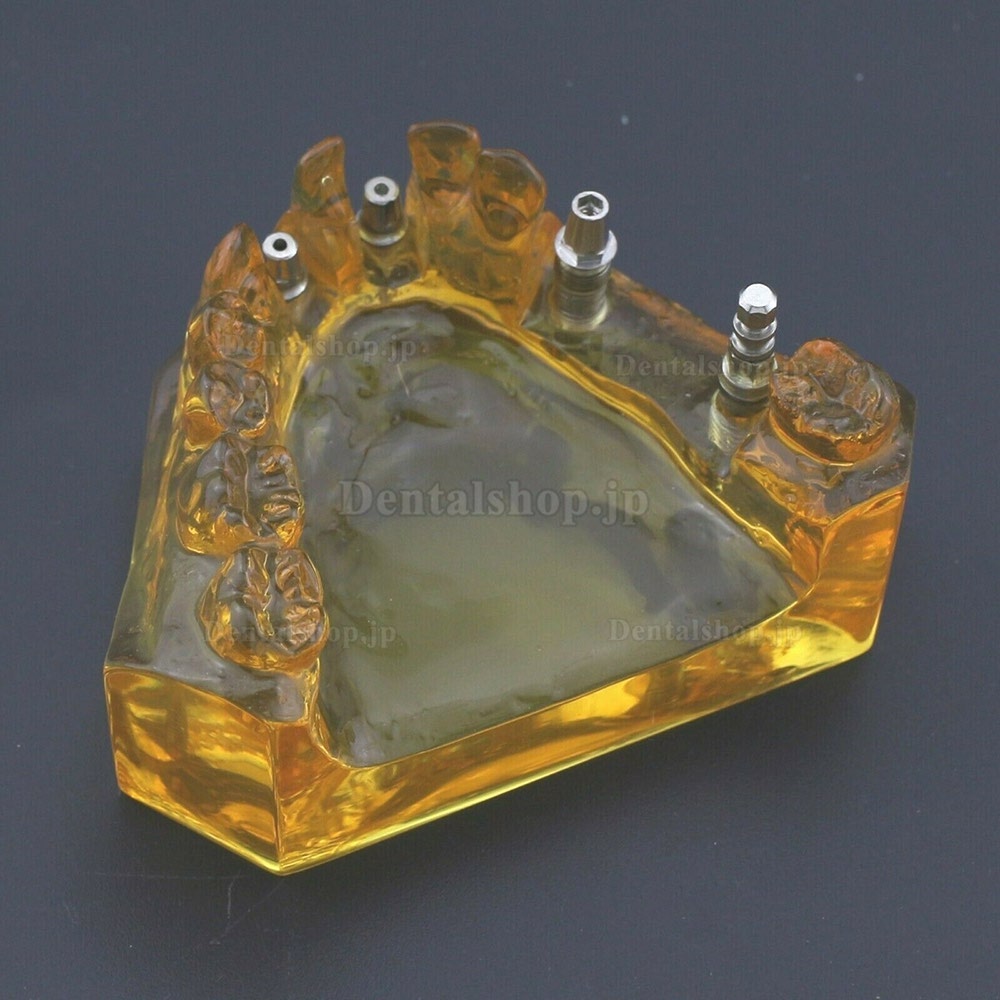 歯科用模型 インプラント 歯科モデル 上顎 デモモデル＃201102