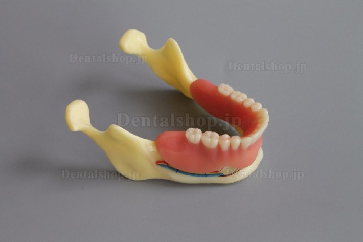 歯科模型＃2014 02 - 下顎インプラントとオーバーデンチャーモデル（黄色）