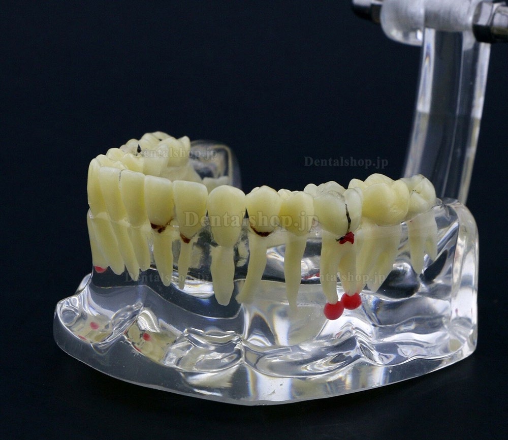 新しい歯科模型 成人病理歯模型 歯列モデル 模型 教学 研究 説明用 #4001