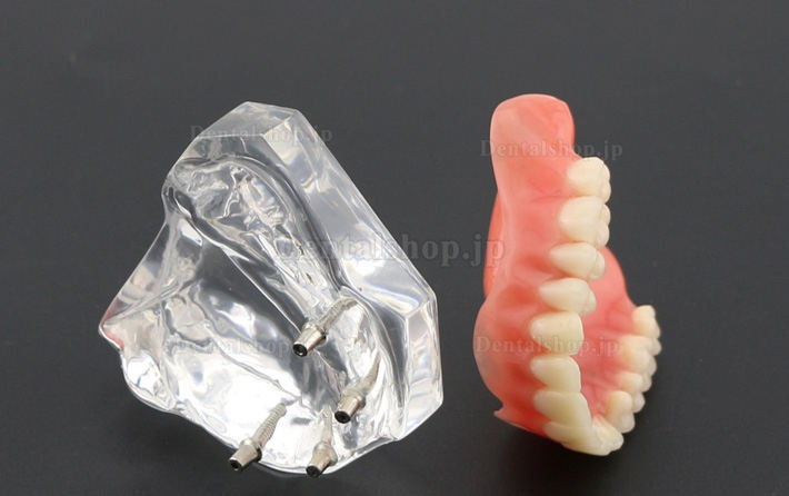 歯科教学用歯モデル上顎重塁義歯4本インプラントデモ6001