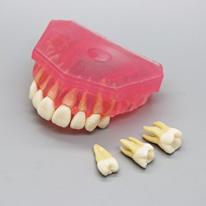 歯科研究治療説明用上下顎義歯模型 高品質脱着可能歯列模型 実用