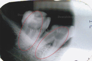 Denjoy® 根管治療器RCTI-DY(I)