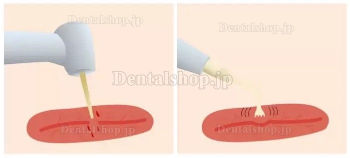 Refine MaxSurgery 超音波骨切削器 歯科用超音波手術ユニット