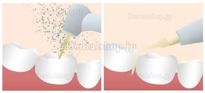 Refine MaxSurgery 超音波骨切削器 歯科用超音波手術ユニット