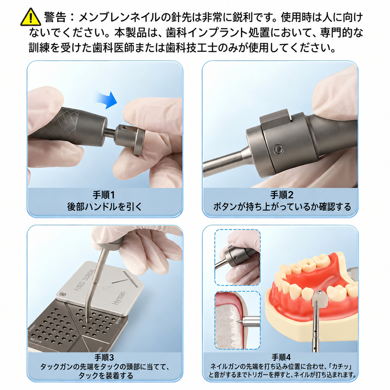 SEGMA 自動ミニボーンタックキット 30本入り 3mm/4mm FGG & GBR チタン釘 SEGMA 自動ミニボーンタックキット 30本入り 3mm/4mm FGG & GBR チタン釘