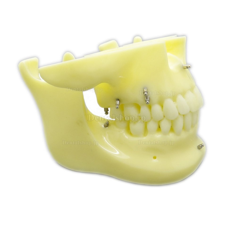 歯科矯正用上下顎歯列模型モデル インプラントモデル スクリューアンカー付き 脱着可能 イエローベース