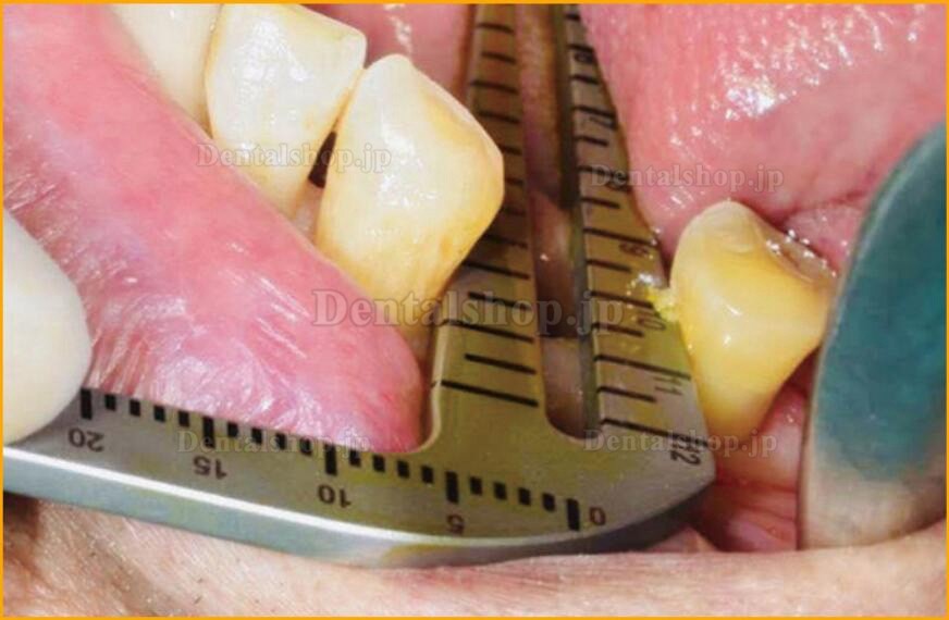 TianTian 歯科用インプラント手術ガイドセット ステンレス鋼 口腔インプラントポジショニング器具角度定規ルーラ