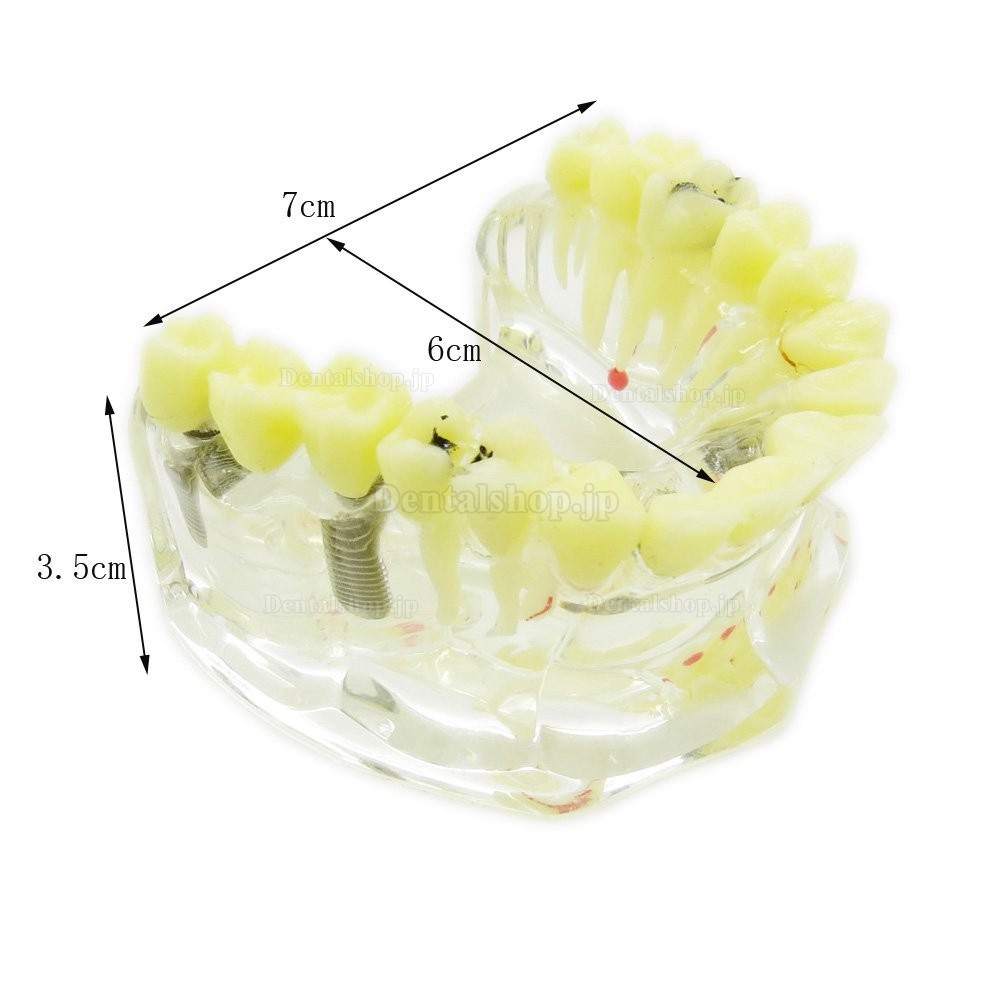 歯科透明インプラントモデル模型 歯科治療説明用虫歯付きの上顎模型 脱着可能