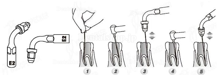 Woodpecker® E2 UDSシリーズ根管治療用チップ(EMSと交換.5本入)
