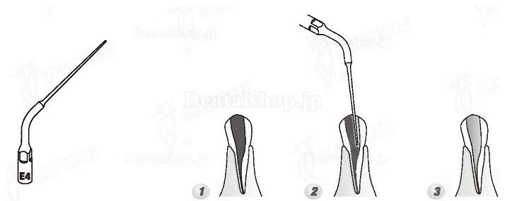 Woodpecker® E4 UDSシリーズ根管治療用チップ(EMSと交換、5本入)