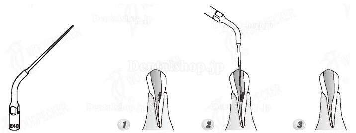 Woodpecker® E4D UDSシリーズ根管治療用チップ(EMSと交換、5本入)