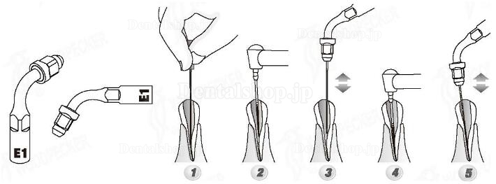 Woodpecker® E1 UDSシリーズ根管治療用チップ(EMSと交換.5本入)