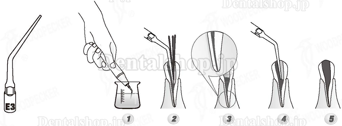 Woodpecker® E3 UDSシリーズ根管治療用チップ（EMSと互換、5本入）