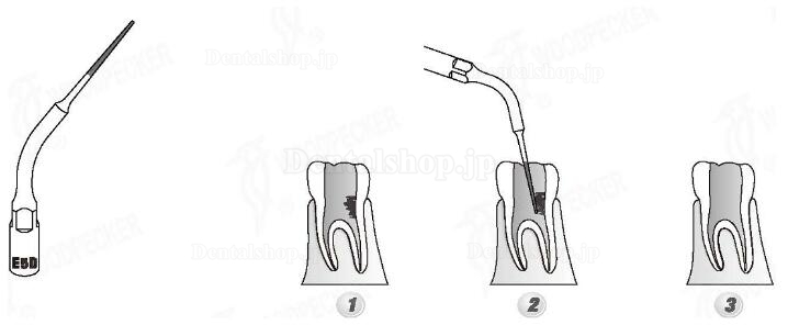 Woodpecker® E5D UDSシリーズ根管治療用チップ(EMSと交換、5本入)