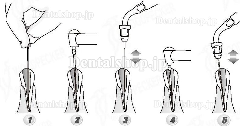 Woodpecker®根管治療用チップED1（SATELECと交換、5本入）