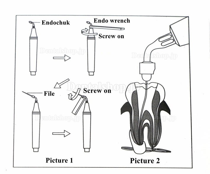 Woodpeckerセット歯科根管NITI KファイルレンチTW-E1 チップE1 E2