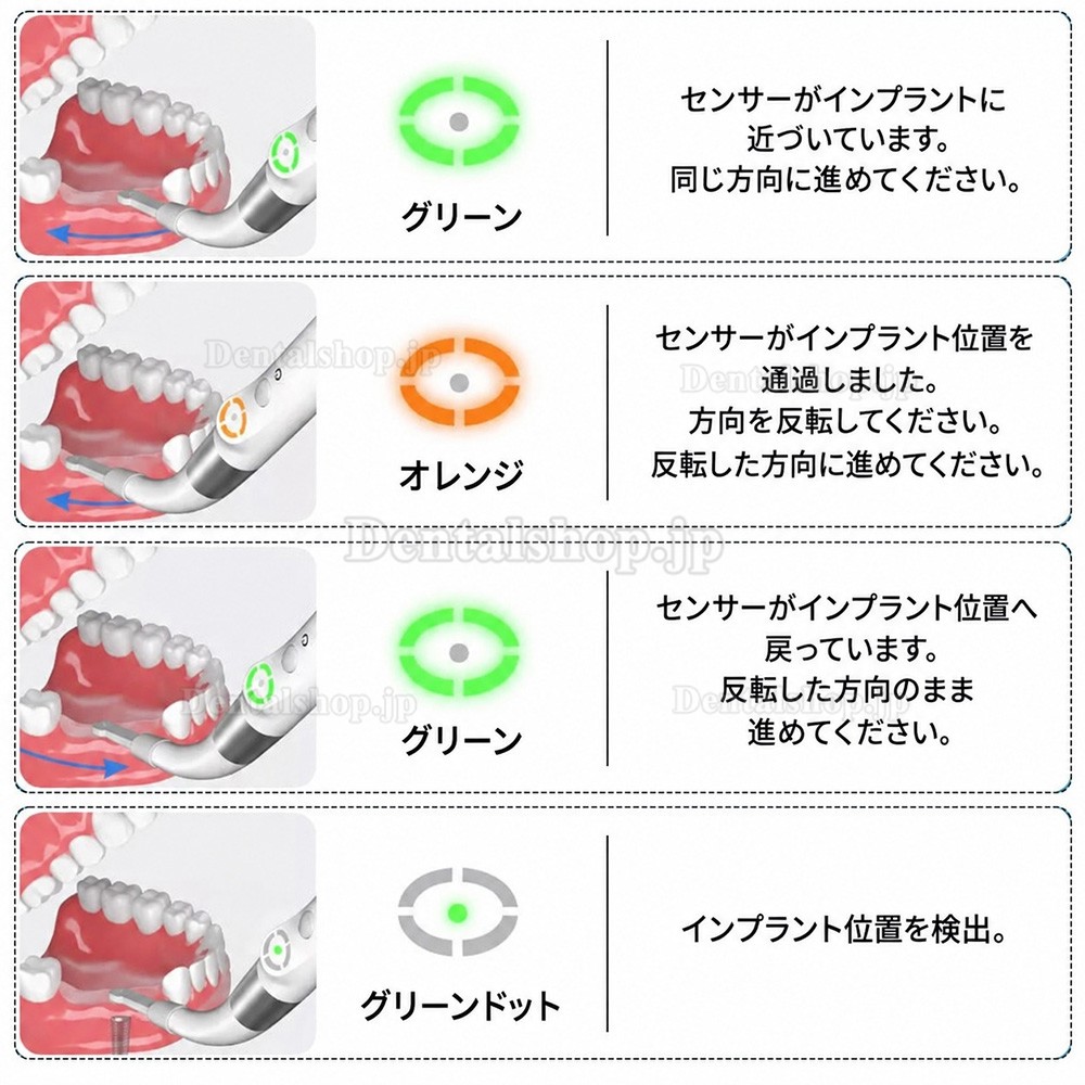 YAHOPE iD1 歯科インプラント検出器 インプラントロケーター スマートファインダー