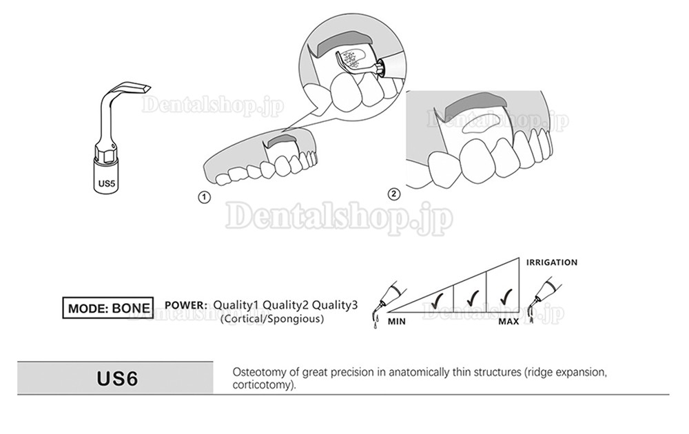 1Pcs 歯科用ピエゾサージェリーチップ 骨切り術 歯科手術チップ US1 US1L US1R US2 US3 US4 US5 US6 US7 US11 US12 Mectron Woodpeckerに適用