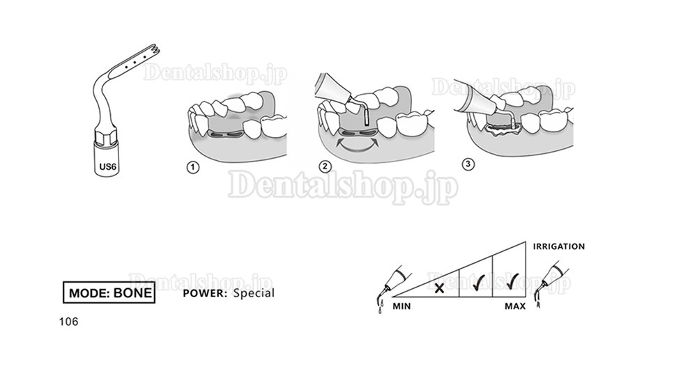 1Pcs 歯科用ピエゾサージェリーチップ 骨切り術 歯科手術チップ US1 US1L US1R US2 US3 US4 US5 US6 US7 US11 US12 Mectron Woodpeckerに適用