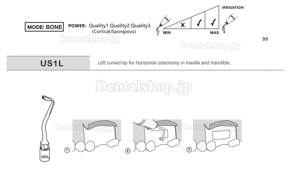 1Pcs 歯科用ピエゾサージェリーチップ 骨切り術 歯科手術チップ US1 US1L US1R US2 US3 US4 US5 US6 US7 US11 US12 Mectron Woodpeckerに適用