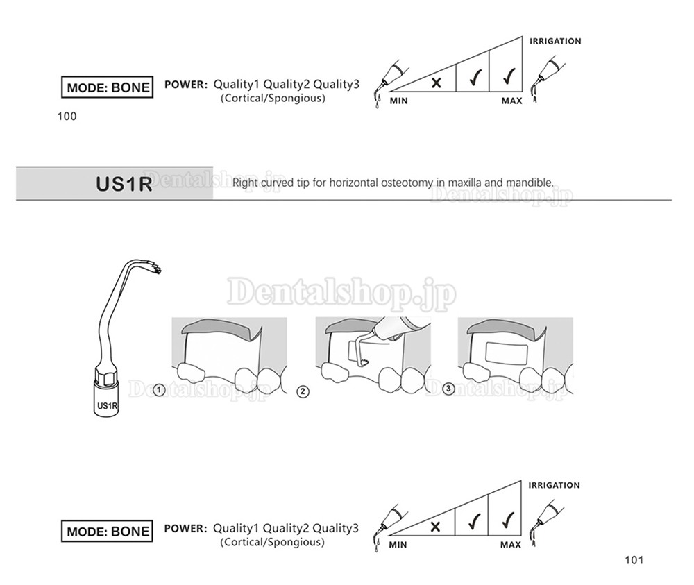 1Pcs 歯科用ピエゾサージェリーチップ 骨切り術 歯科手術チップ US1 US1L US1R US2 US3 US4 US5 US6 US7 US11 US12 Mectron Woodpeckerに適用