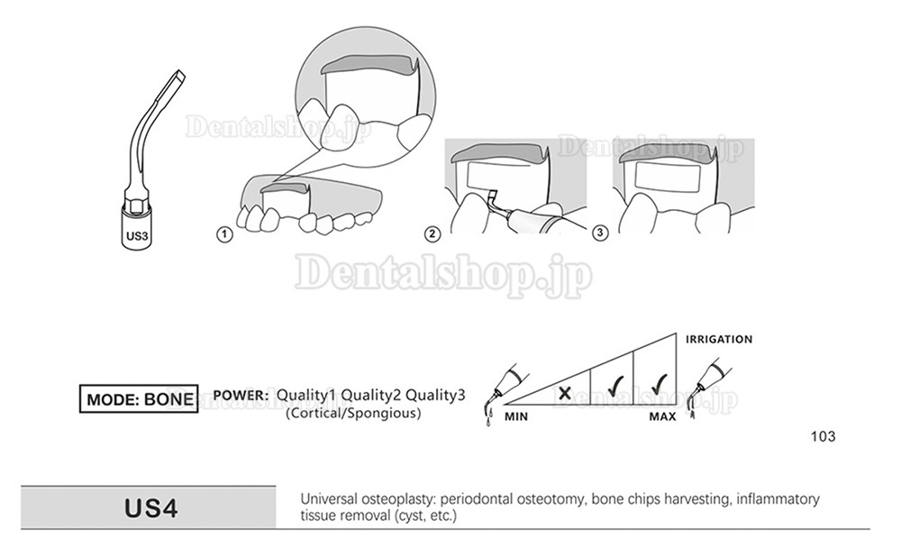 1Pcs 歯科用ピエゾサージェリーチップ 骨切り術 歯科手術チップ US1 US1L US1R US2 US3 US4 US5 US6 US7 US11 US12 Mectron Woodpeckerに適用